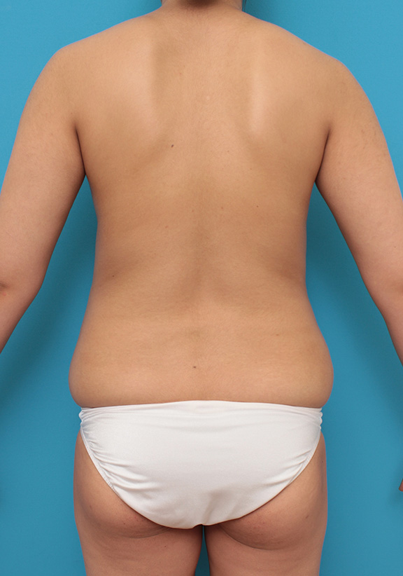 脂肪吸引,お腹回りと二の腕から脂肪吸引し、バストに脂肪注入した30代前半女性の症例写真,Before,ba_shibokyuin030_b04.jpg