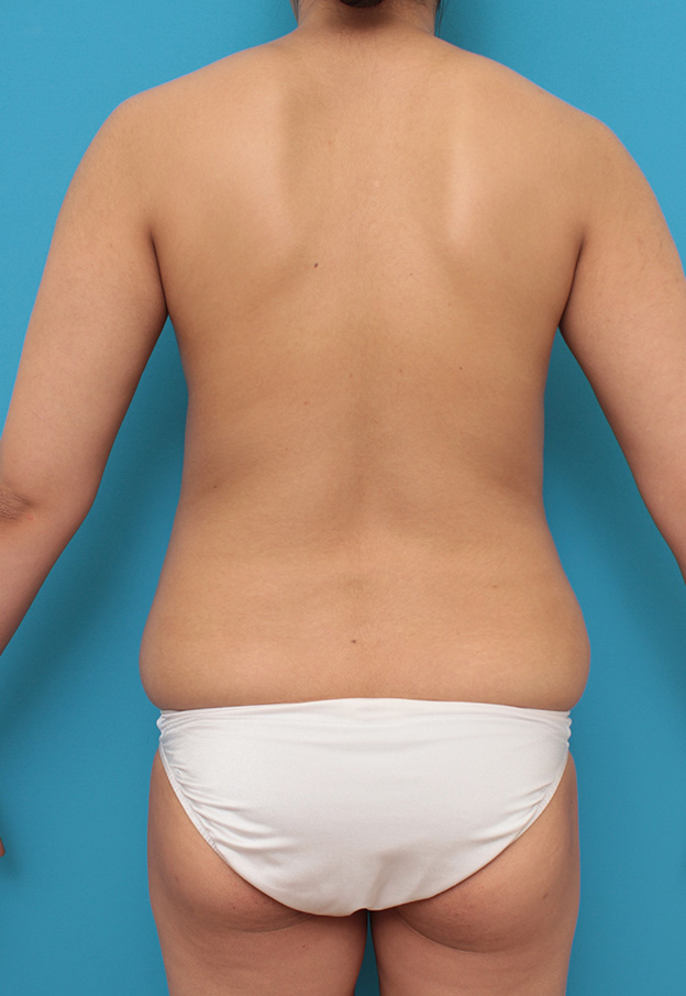 脂肪吸引,お腹回りと二の腕から脂肪吸引し、バストに脂肪注入した30代前半女性の症例写真,手術前,mainpic_shibokyuin030f.jpg