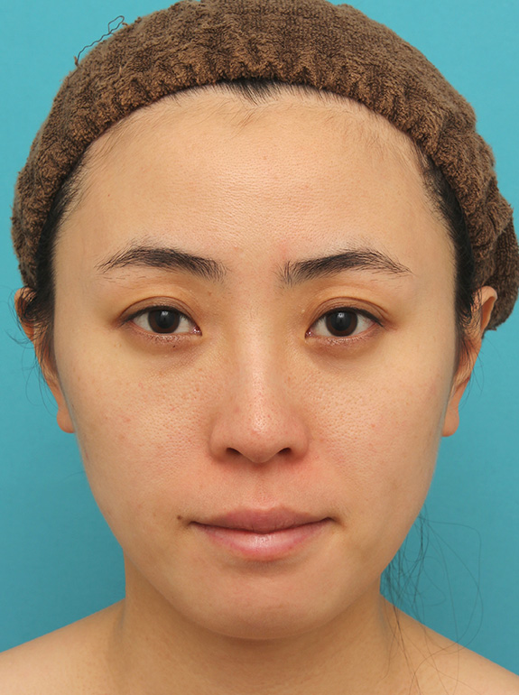 顔と首にウルセラシステムを行い、リフトアップと引き締め効果を出した20代後半女性の症例写真,After（3ヶ月後）,ba_ulthera018_a01.jpg