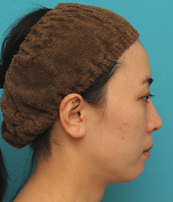 ウルセラシステム,顔と首にウルセラシステムを行い、リフトアップと引き締め効果を出した20代後半女性の症例写真,After（3ヶ月後）,ba_ulthera018_b02.jpg