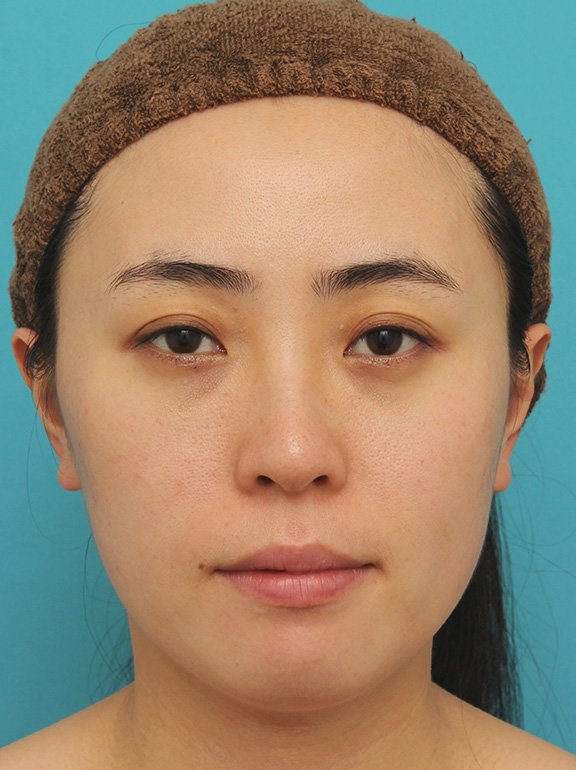 ウルセラシステム,顔と首にウルセラシステムを行い、リフトアップと引き締め効果を出した20代後半女性の症例写真,Before,ba_ulthera018_b01.jpg