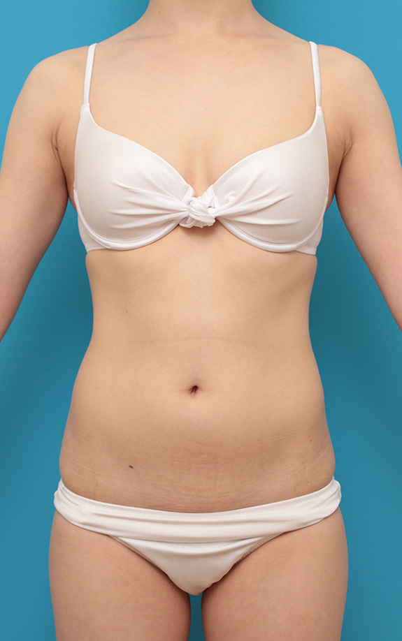 お腹周りにイタリアン・メソシェイプ（イタリアンメソセラピー）・脂肪溶解注射を行い、一回り細くした20代女性の症例写真,After（6回目注射後）,ba_meso040_a01.jpg