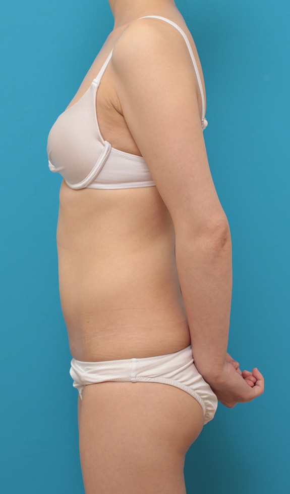 イタリアン・メソシェイプ（イタリアンメソセラピー）・脂肪溶解注射,お腹周りにイタリアン・メソシェイプ（イタリアンメソセラピー）・脂肪溶解注射を行い、一回り細くした20代女性の症例写真,After（6回目注射後）,ba_meso040_b03.jpg