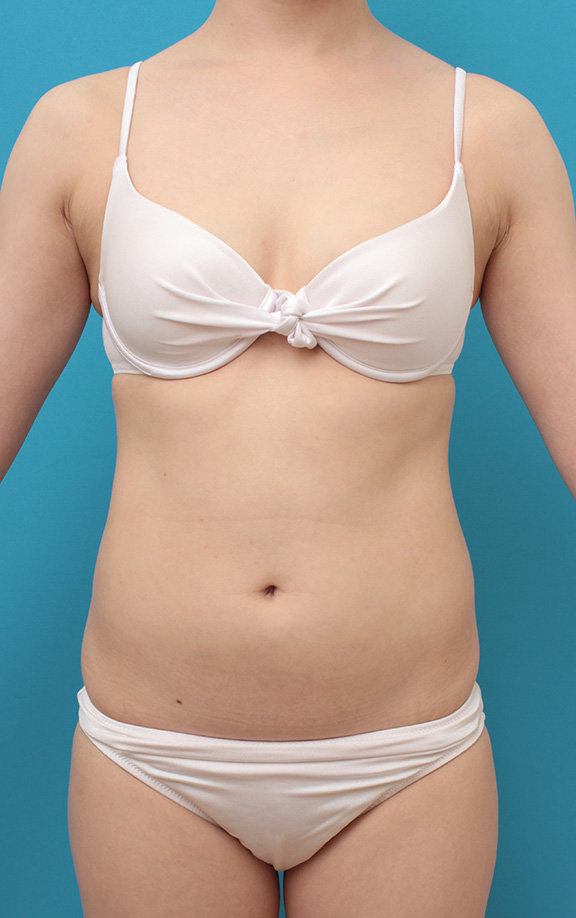 お腹周りにイタリアン・メソシェイプ（イタリアンメソセラピー）・脂肪溶解注射を行い、一回り細くした20代女性の症例写真,Before,ba_meso040_b01.jpg