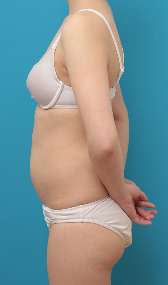 イタリアン・メソシェイプ（イタリアンメソセラピー）・脂肪溶解注射,お腹周りにイタリアン・メソシェイプ（イタリアンメソセラピー）・脂肪溶解注射を行い、一回り細くした20代女性の症例写真,Before,ba_meso040_b03.jpg
