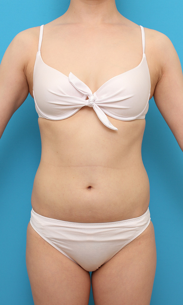 症例写真,お腹周りにイタリアン・メソシェイプ（イタリアンメソセラピー）・脂肪溶解注射を行い、一回り細くした20代女性の症例写真,3回目注射後,mainpic_meso040c.jpg