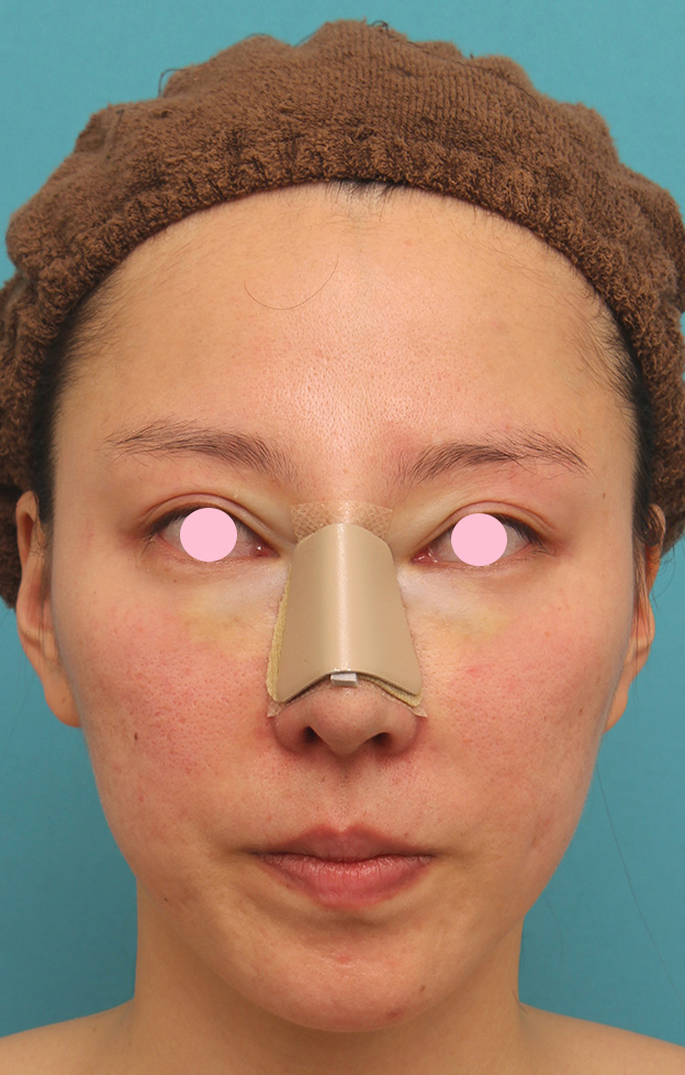 骨切幅寄せ（鼻の根元を細く）,ハンプ切除+鼻骨切り幅寄せ手術を行った20代女性の症例写真,手術直後,mainpic_hump011b.jpg
