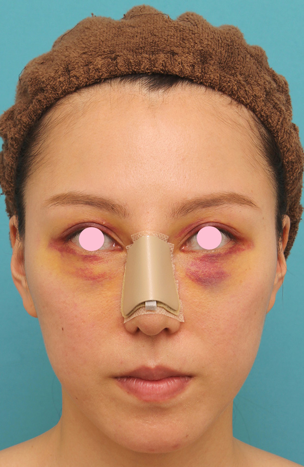 骨切幅寄せ（鼻の根元を細く）,ハンプ切除+鼻骨切り幅寄せ手術を行った20代女性の症例写真,4日後,mainpic_hump011c.jpg