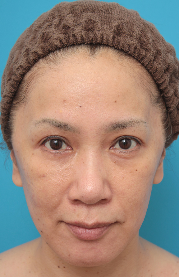ミニフェイスリフト（頬のたるみ取り）,ミニフェイスリフト（頬のたるみ取り）で頬のたるみがリフトアップした50代女性の症例写真,After（6ヶ月後）,ba_minilift005_b01.jpg