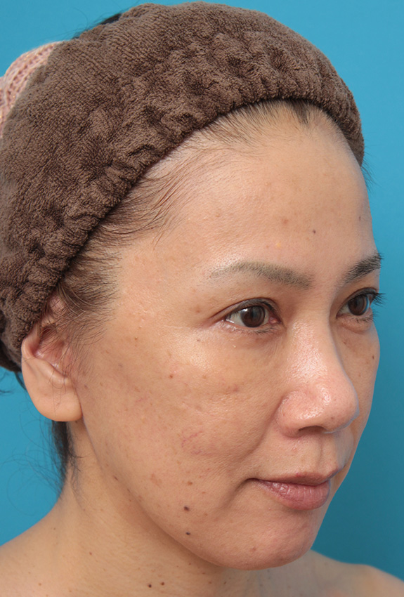 ミニフェイスリフト（頬のたるみ取り）,ミニフェイスリフト（頬のたるみ取り）で頬のたるみがリフトアップした50代女性の症例写真,After（6ヶ月後）,ba_minilift005_b02.jpg