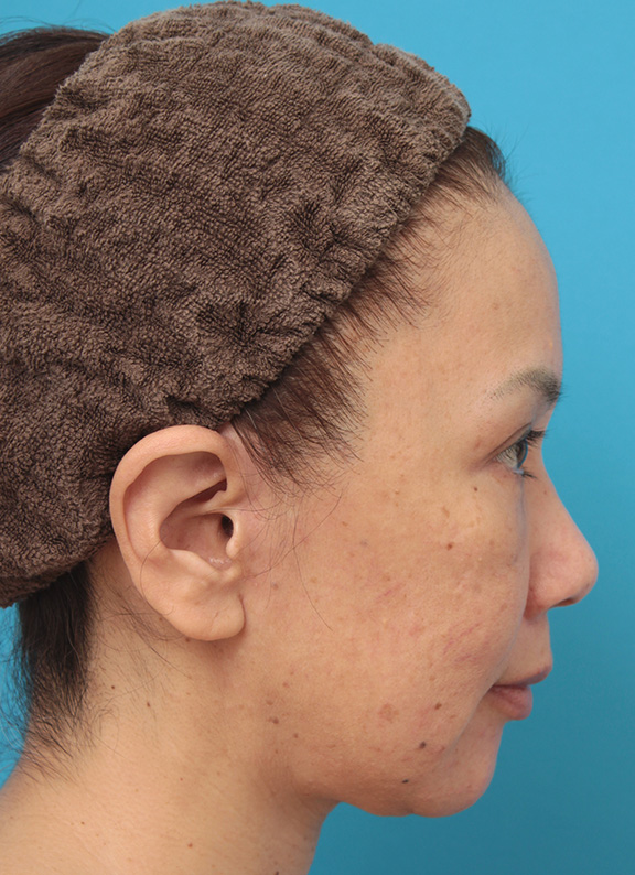 ミニフェイスリフト（頬のたるみ取り）,ミニフェイスリフト（頬のたるみ取り）で頬のたるみがリフトアップした50代女性の症例写真,After（6ヶ月後）,ba_minilift005_b03.jpg