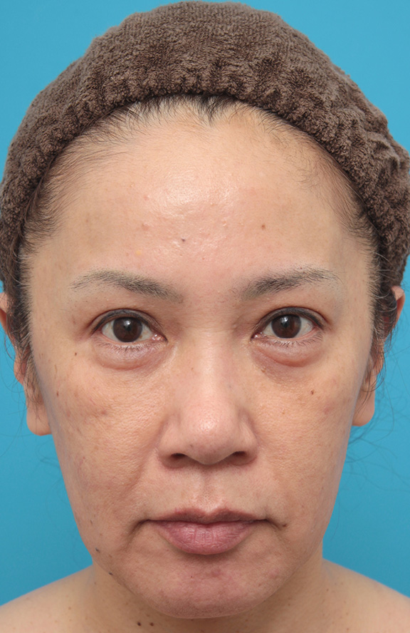 ミニフェイスリフト（頬のたるみ取り）で頬のたるみがリフトアップした50代女性の症例写真,Before,ba_minilift005_b01.jpg