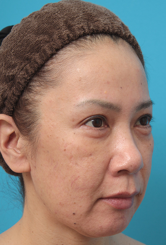 ミニフェイスリフト（頬のたるみ取り）,ミニフェイスリフト（頬のたるみ取り）で頬のたるみがリフトアップした50代女性の症例写真,Before,ba_minilift005_b02.jpg