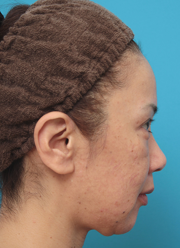 ミニフェイスリフト（頬のたるみ取り）,ミニフェイスリフト（頬のたるみ取り）で頬のたるみがリフトアップした50代女性の症例写真,Before,ba_minilift005_b03.jpg