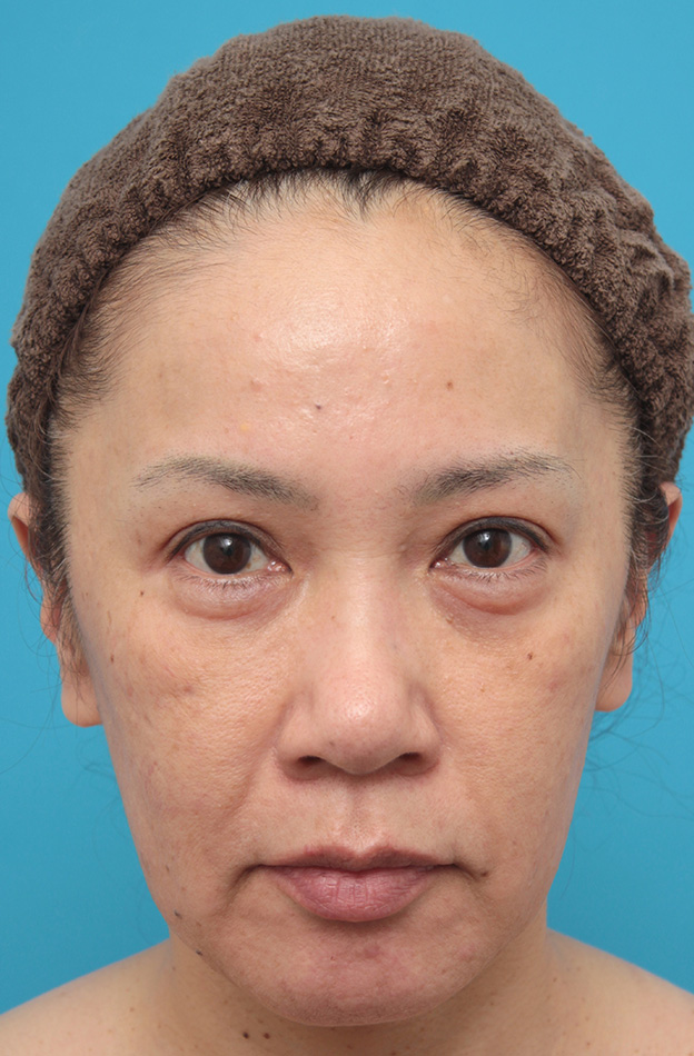 ミニフェイスリフト（頬のたるみ取り）,ミニフェイスリフト（頬のたるみ取り）で頬のたるみがリフトアップした50代女性の症例写真,手術前,mainpic_minilift005a.jpg