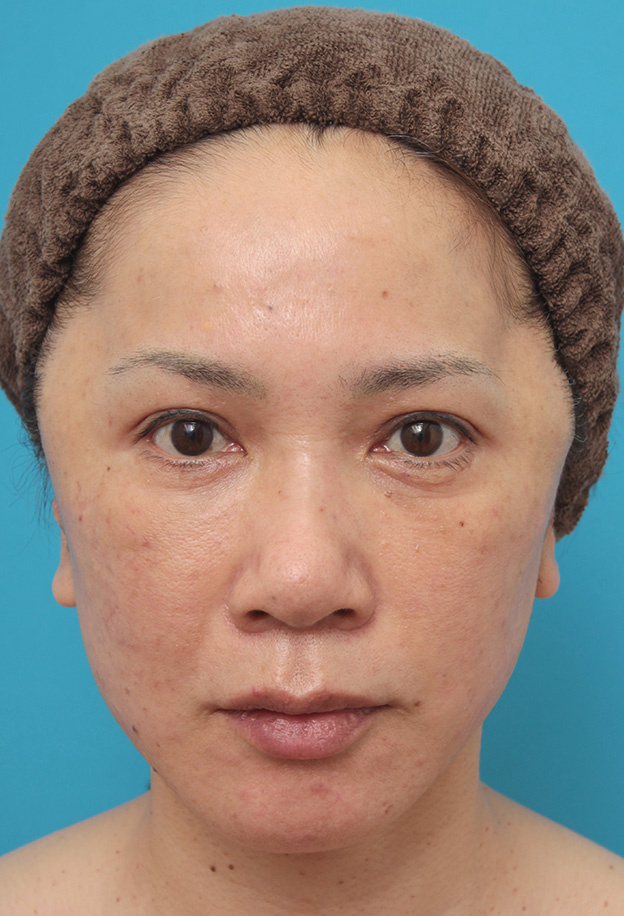 ミニフェイスリフト（頬のたるみ取り）,ミニフェイスリフト（頬のたるみ取り）で頬のたるみがリフトアップした50代女性の症例写真,手術直後,mainpic_minilift005b.jpg