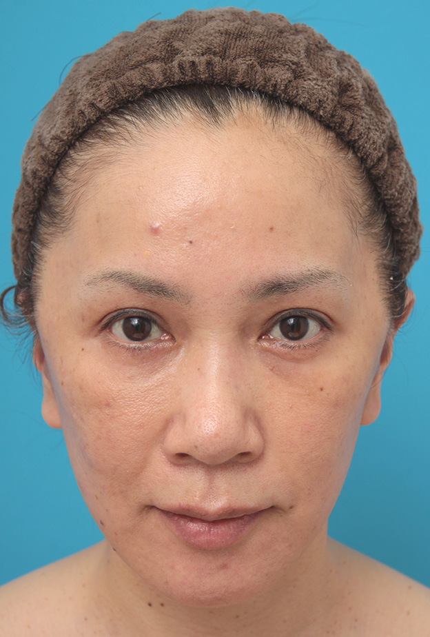ミニフェイスリフト（頬のたるみ取り）,ミニフェイスリフト（頬のたるみ取り）で頬のたるみがリフトアップした50代女性の症例写真,1週間後,mainpic_minilift005c.jpg