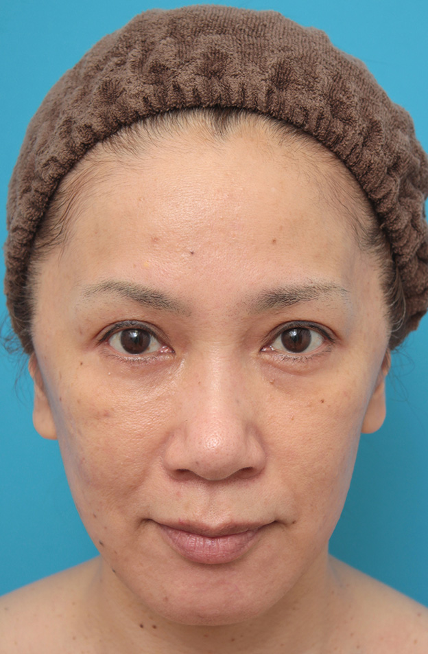 ミニフェイスリフト（頬のたるみ取り）,ミニフェイスリフト（頬のたるみ取り）で頬のたるみがリフトアップした50代女性の症例写真,6ヶ月後,mainpic_minilift005d.jpg