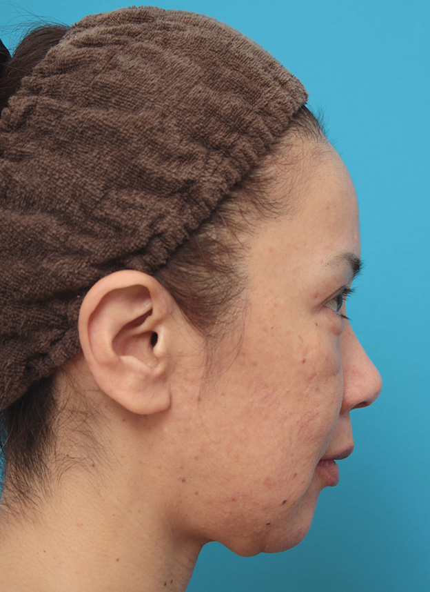 ミニフェイスリフト（頬のたるみ取り）,ミニフェイスリフト（頬のたるみ取り）で頬のたるみがリフトアップした50代女性の症例写真,手術前,mainpic_minilift005e.jpg