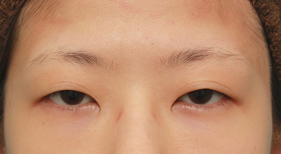 眼瞼下垂（がんけんかすい）,眼瞼下垂（がんけんかすい）の症例写真 眼瞼下垂手術＋二重まぶた全切開法,Before,ba_ganken035_b01.jpg