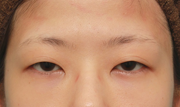 眼瞼下垂（がんけんかすい）,眼瞼下垂（がんけんかすい）の症例写真 眼瞼下垂手術＋二重まぶた全切開法,手術前,mainpic_ganken035a.jpg