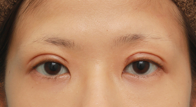眼瞼下垂（がんけんかすい）,眼瞼下垂（がんけんかすい）の症例写真 眼瞼下垂手術＋二重まぶた全切開法,3週間後,mainpic_ganken035d.jpg