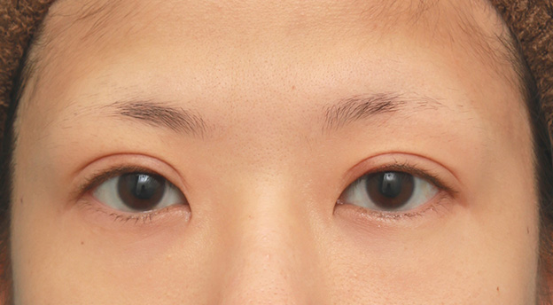 眼瞼下垂（がんけんかすい）,眼瞼下垂（がんけんかすい）の症例写真 眼瞼下垂手術＋二重まぶた全切開法,4ヶ月後,mainpic_ganken035e.jpg