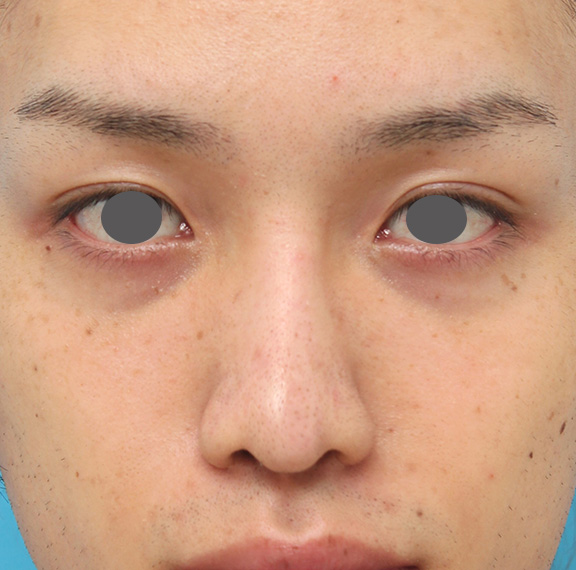 隆鼻術（シリコンプロテーゼ）,5mmのI型シリコンプロテーゼを鼻に入れて高くし、鼻筋を通した症例写真,After（6ヶ月後）,ba_ryubi1043_b01.jpg