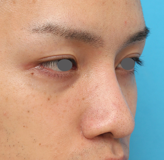 隆鼻術（シリコンプロテーゼ）,5mmのI型シリコンプロテーゼを鼻に入れて高くし、鼻筋を通した症例写真,After（6ヶ月後）,ba_ryubi1043_b02.jpg