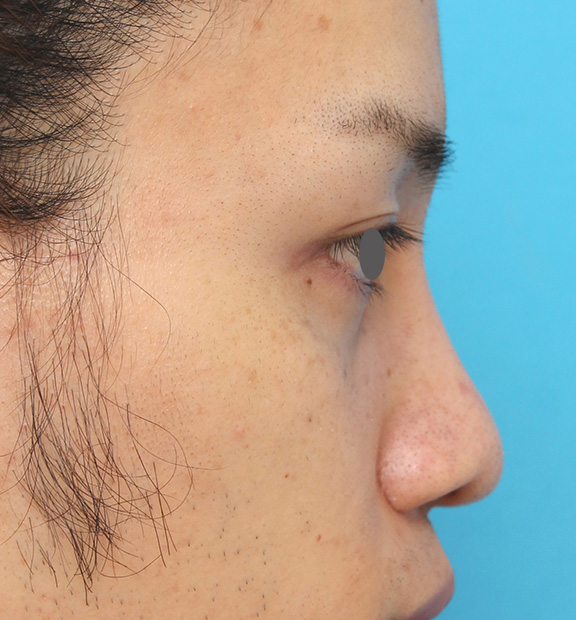 隆鼻術（シリコンプロテーゼ）,5mmのI型シリコンプロテーゼを鼻に入れて高くし、鼻筋を通した症例写真,After（6ヶ月後）,ba_ryubi1043_b03.jpg