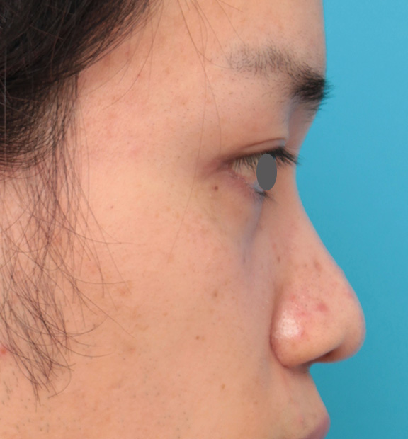 隆鼻術（シリコンプロテーゼ）,5mmのI型シリコンプロテーゼを鼻に入れて高くし、鼻筋を通した症例写真,Before,ba_ryubi1043_b03.jpg