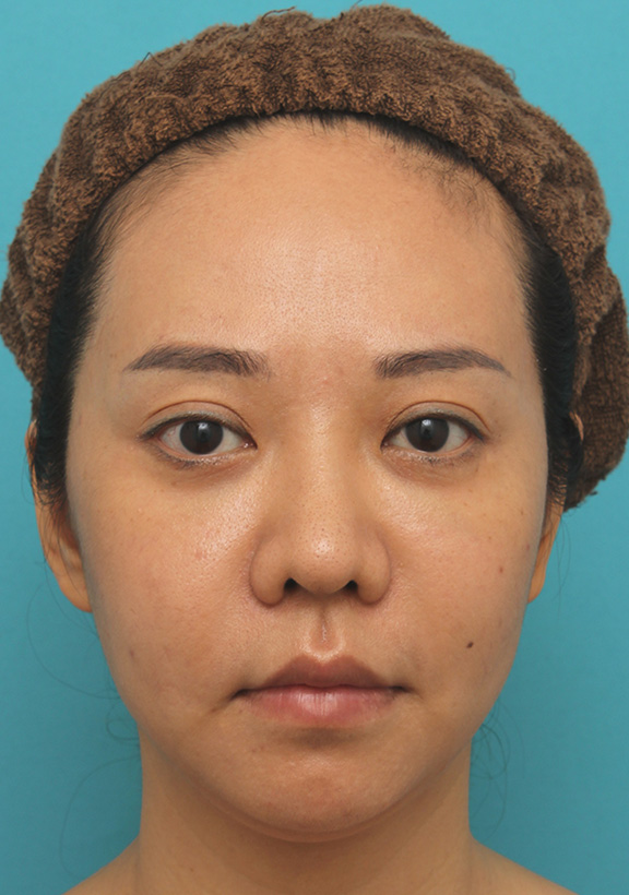 症例写真,ウルセラシステムで顔と顎下のたるみを引き締めた30代後半女性の症例写真,Before,ba_ulthera019_b01.jpg