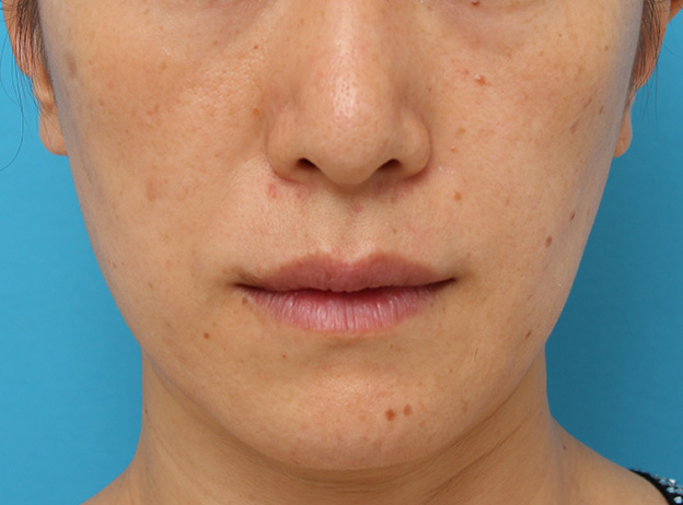 ボツリヌストキシン注射（口角を上げる）,ボツリヌストキシン注射で下がっている口角を上げた40代後半女性の症例写真,1ヶ月後,mainpic_lipsup_botox006c.jpg