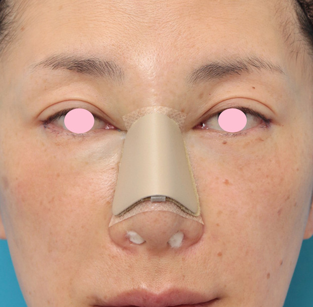 骨切幅寄せ（鼻の根元を細く）,骨切り幅寄せ手術で鼻の横幅を小さくした40代女性の症例写真,手術直後,mainpic_honekiri009b.jpg