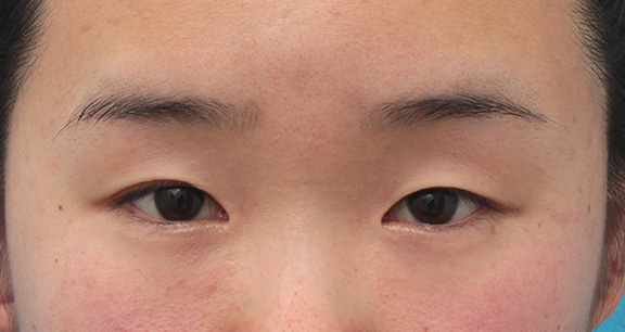症例写真,その人の目に一番合ったラインで二重まぶた全切開法をした症例写真,Before,ba_sekkai053_b01.jpg
