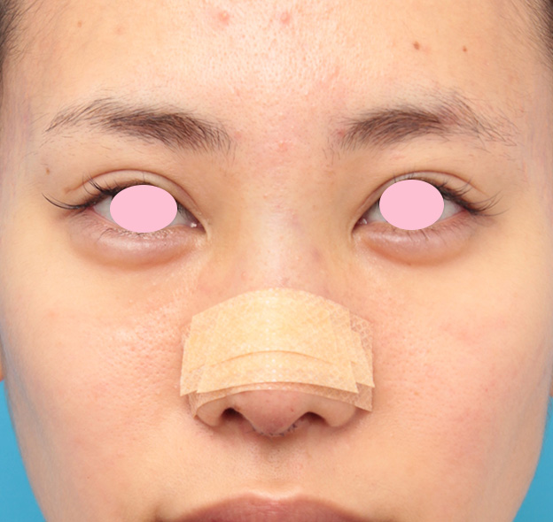 鼻のシリコンプロテーゼ抜き（除去）,他院で受けた鼻中隔延長+ゴアテックスの修正手術の症例写真,修正手術直後,mainpic_nose_modify020b.jpg