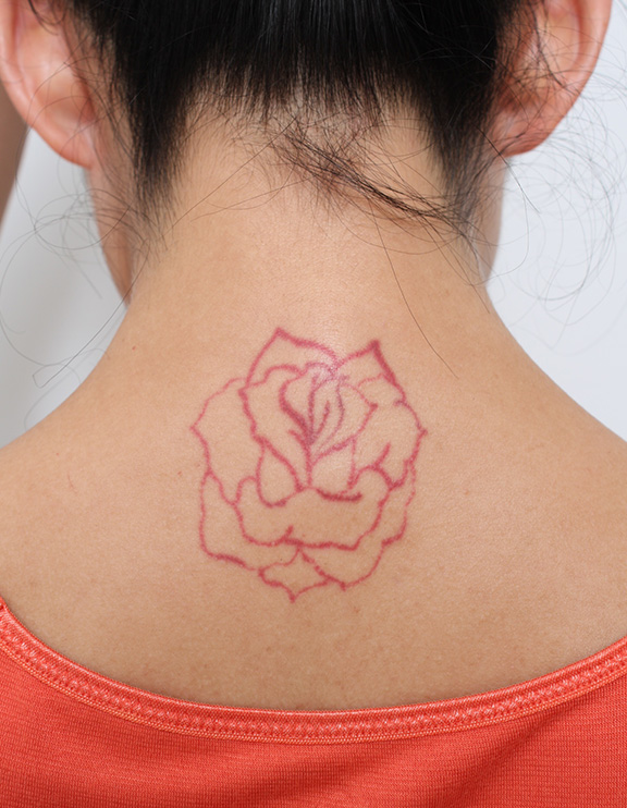 刺青（タトゥー）除去,首の後ろの赤色の大きな入れ墨を剥削手術で除去した症例写真,Before,ba_irezumi031_b01.jpg