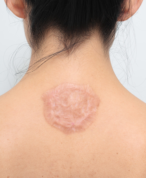 刺青（タトゥー）除去,首の後ろの赤色の大きな入れ墨を剥削手術で除去した症例写真,1年後,mainpic_irezumi031g.jpg