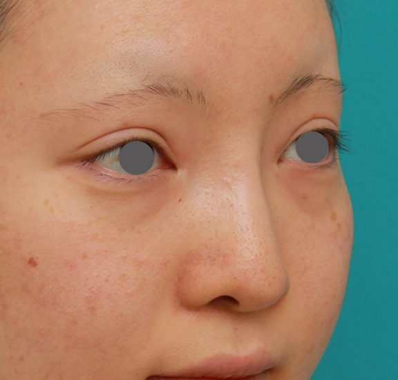 隆鼻術（シリコンプロテーゼ）,鼻のヒアルロン酸を溶解し、シリコンプロテーゼ+鼻先耳介軟骨移植をした症例写真,After（6ヶ月後）,ba_ryubi1046_b02.jpg