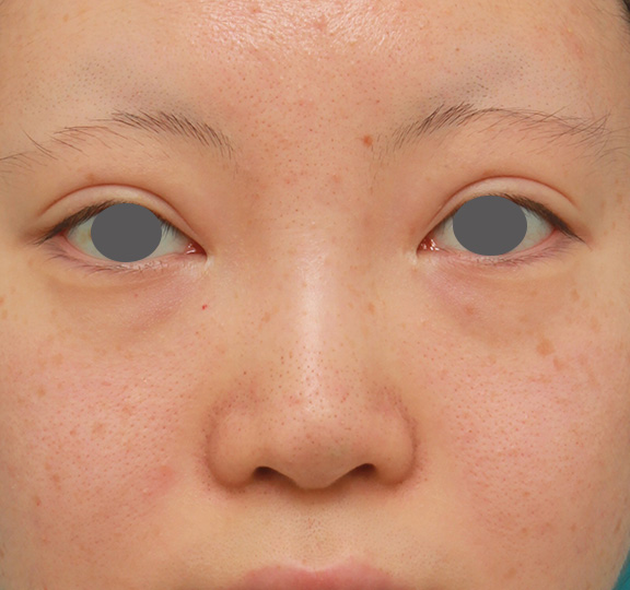 隆鼻術（シリコンプロテーゼ）,鼻のヒアルロン酸を溶解し、シリコンプロテーゼ+鼻先耳介軟骨移植をした症例写真,Before,ba_ryubi1046_b01.jpg