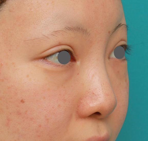 隆鼻術（シリコンプロテーゼ）,鼻のヒアルロン酸を溶解し、シリコンプロテーゼ+鼻先耳介軟骨移植をした症例写真,Before,ba_ryubi1046_b02.jpg