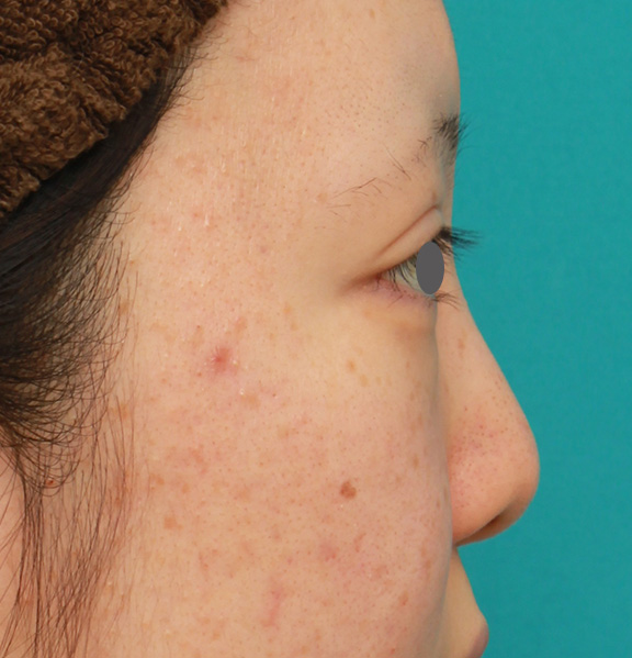 耳介軟骨移植（鼻先を出す）,鼻のヒアルロン酸を溶解し、シリコンプロテーゼ+鼻先耳介軟骨移植をした症例写真,Before,ba_ryubi1046_b03.jpg