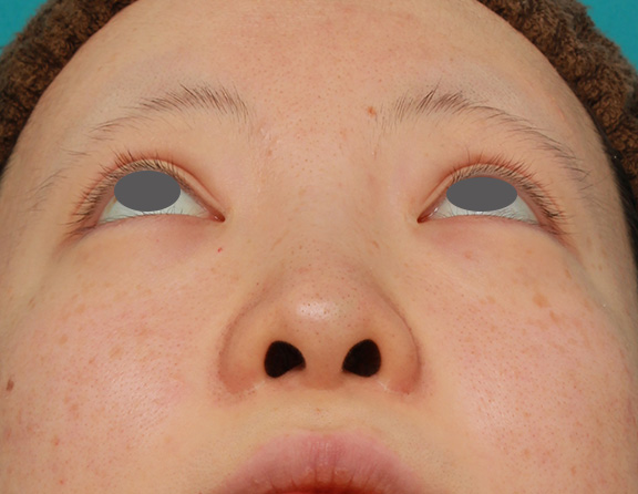 隆鼻術（シリコンプロテーゼ）,鼻のヒアルロン酸を溶解し、シリコンプロテーゼ+鼻先耳介軟骨移植をした症例写真,Before,ba_ryubi1046_b04.jpg