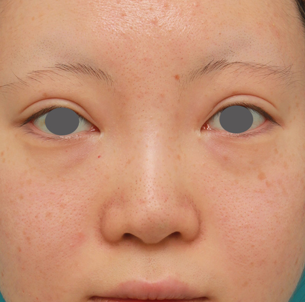 隆鼻術（シリコンプロテーゼ）,鼻のヒアルロン酸を溶解し、シリコンプロテーゼ+鼻先耳介軟骨移植をした症例写真,手術前,mainpic_ryubi1046a.jpg