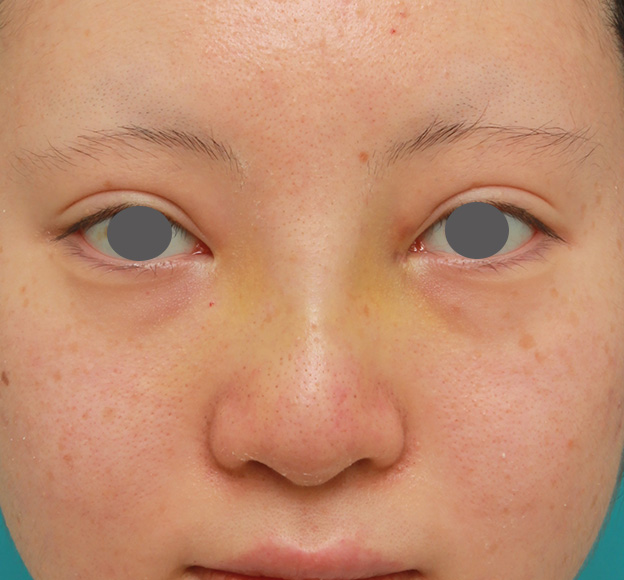 症例写真,鼻のヒアルロン酸を溶解し、シリコンプロテーゼ+鼻先耳介軟骨移植をした症例写真,6日後,mainpic_ryubi1046c.jpg