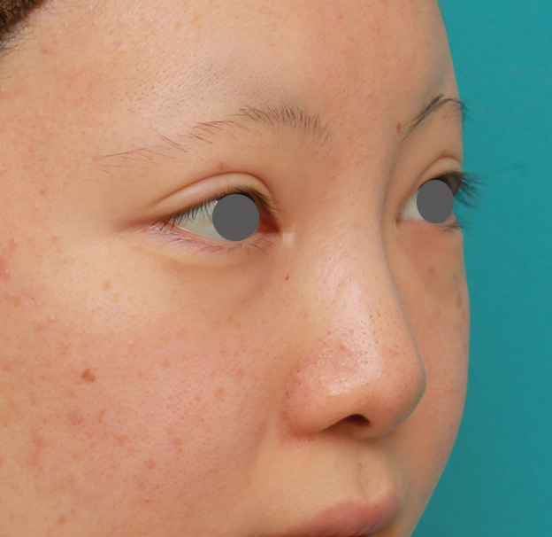 隆鼻術（シリコンプロテーゼ）,鼻のヒアルロン酸を溶解し、シリコンプロテーゼ+鼻先耳介軟骨移植をした症例写真,手術前,mainpic_ryubi1046f.jpg