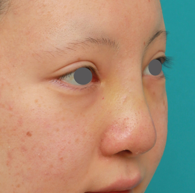 隆鼻術（シリコンプロテーゼ）,鼻のヒアルロン酸を溶解し、シリコンプロテーゼ+鼻先耳介軟骨移植をした症例写真,6日後,mainpic_ryubi1046h.jpg