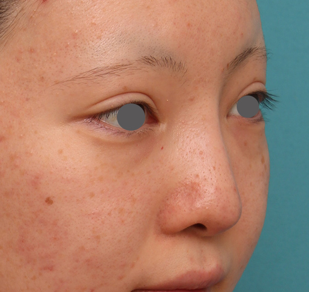 隆鼻術（シリコンプロテーゼ）,鼻のヒアルロン酸を溶解し、シリコンプロテーゼ+鼻先耳介軟骨移植をした症例写真,3週間後,mainpic_ryubi1046i.jpg