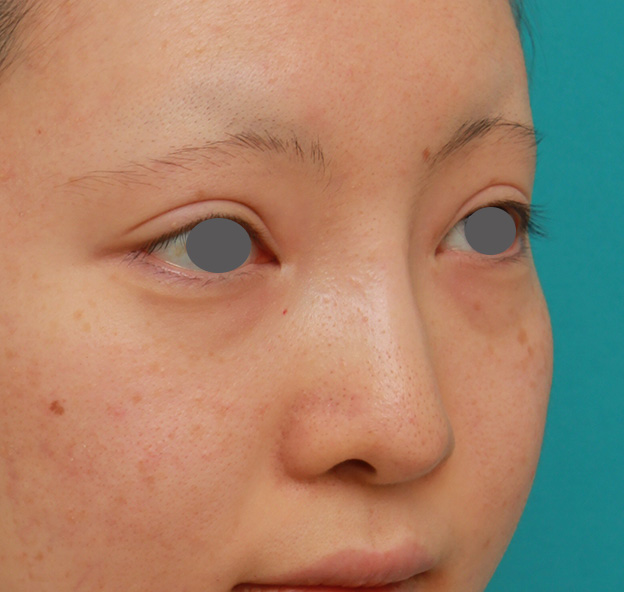 隆鼻術（シリコンプロテーゼ）,鼻のヒアルロン酸を溶解し、シリコンプロテーゼ+鼻先耳介軟骨移植をした症例写真,6ヶ月後,mainpic_ryubi1046j.jpg