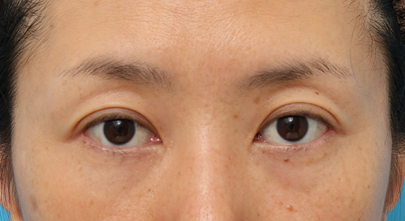 目尻切開,目尻切開で目を外側に広げた40代後半の女性の症例写真,After（6ヶ月後）,ba_mejiri016_a01.jpg